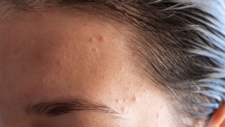 A closeup on someone's forehead with acne on it.