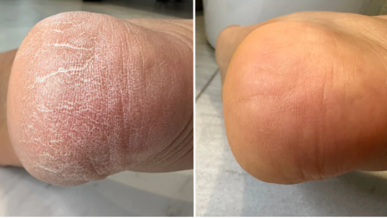 cracked heel before and after serum
