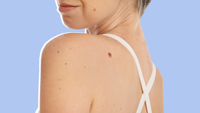 Person displaying shoulder with moles on skin.