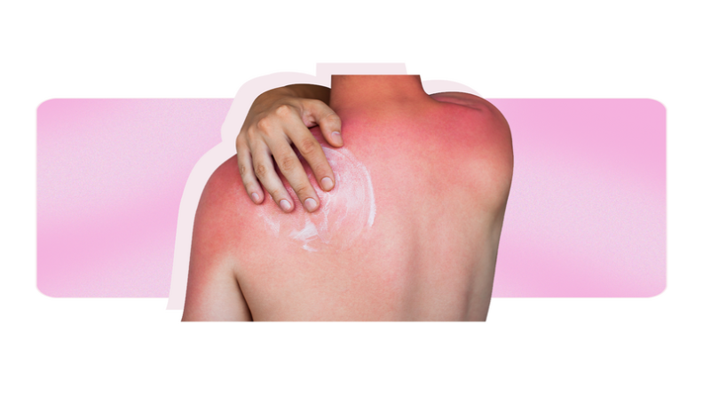 A person uses cream to alleviate a sunburn.