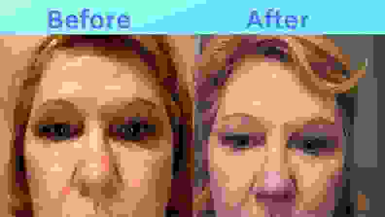 Side-by-side images of Sue's forehead before and after SiO
