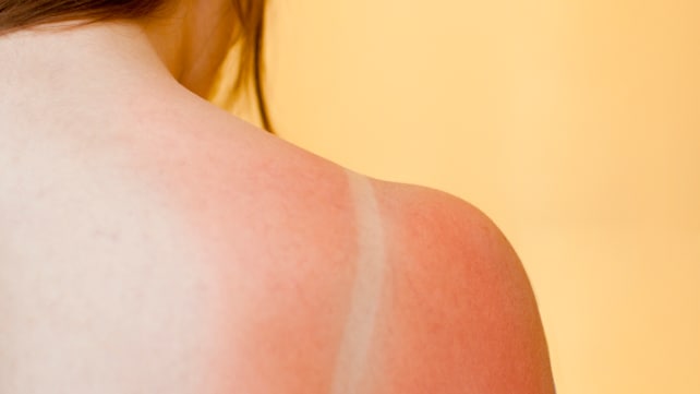 How to treat a sunburn