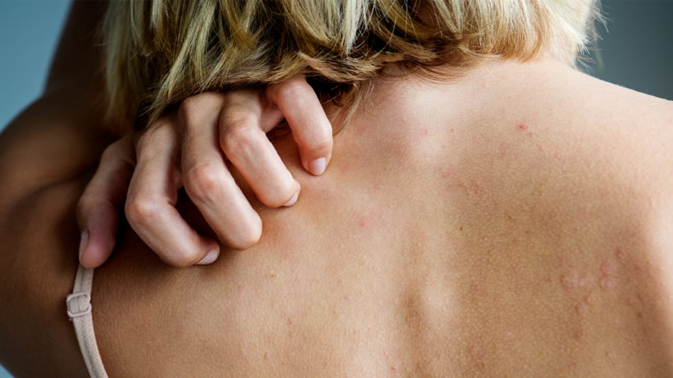 What Is Psoriasis—and How Can You Treat It Reviewed 