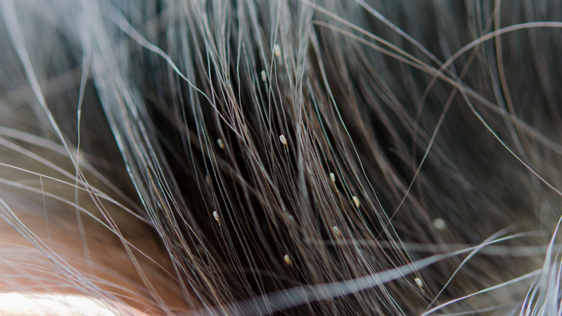Lice look like sesame seeds in your child's hair.