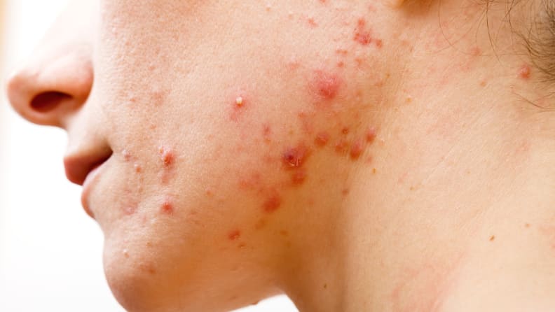 A closeup on someone's jaw with red, inflamed acne on it.