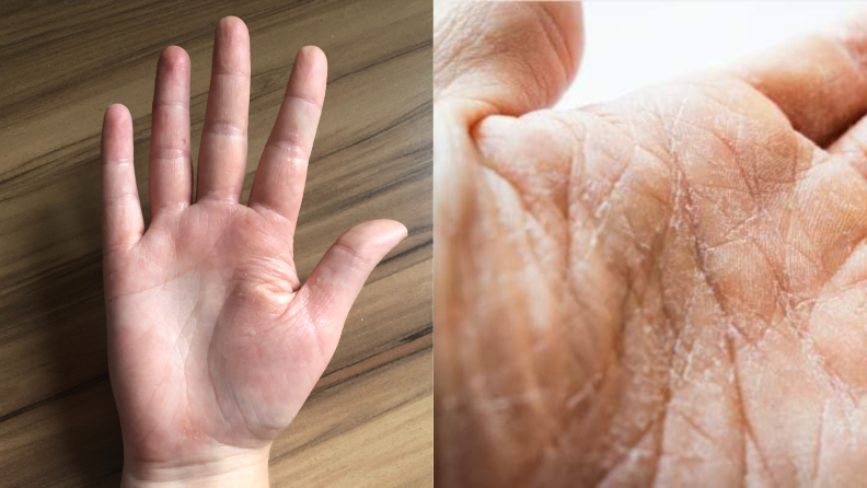 Hands with dry and flaking skin.
