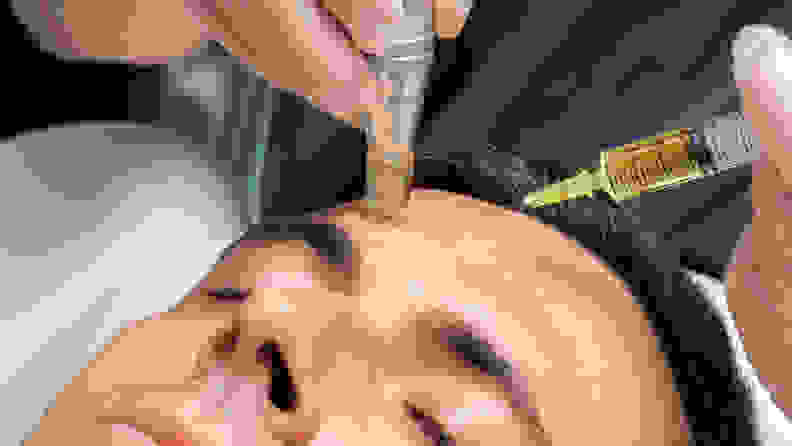 A closeup of a person's face while they lay on a dermatologist's table with a needle and a microneedling tool on their forehead.
