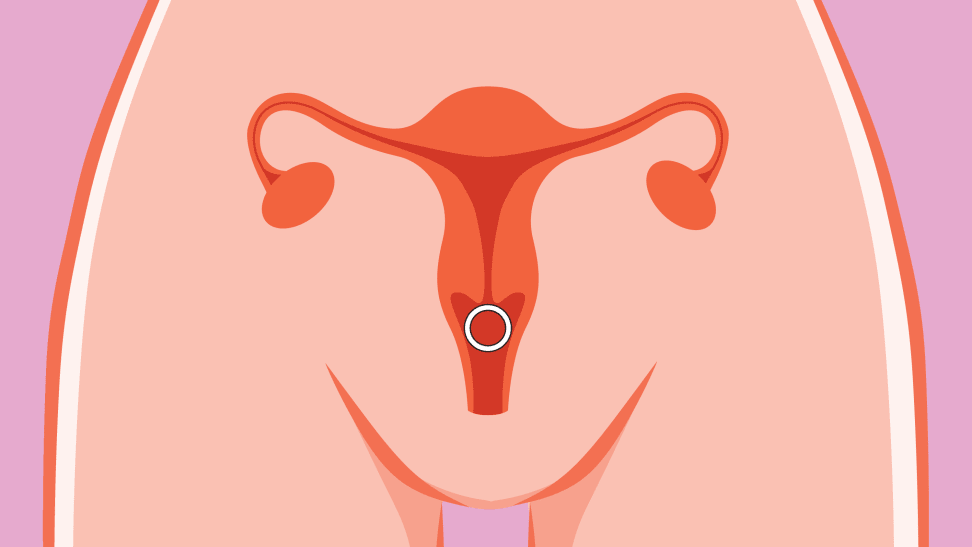 Infographic of hormonal birth control ring inserted into cartoon uterus.