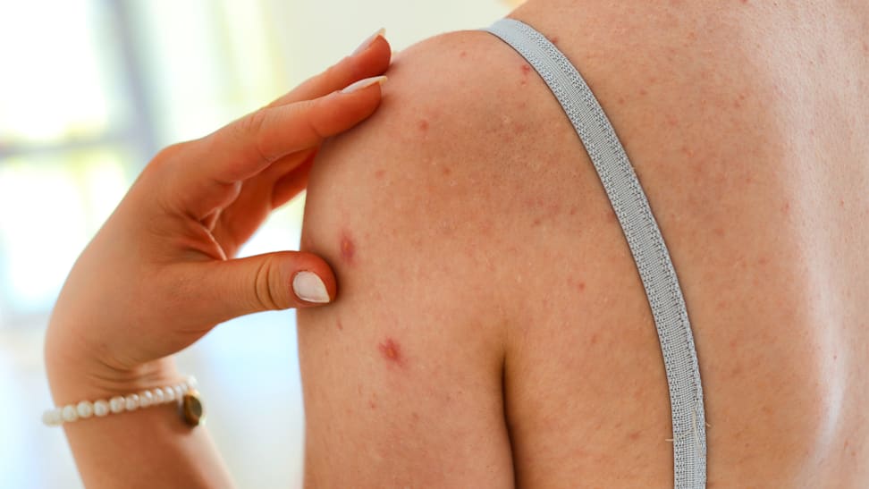 Here's why you have acne, according to where it is on your body