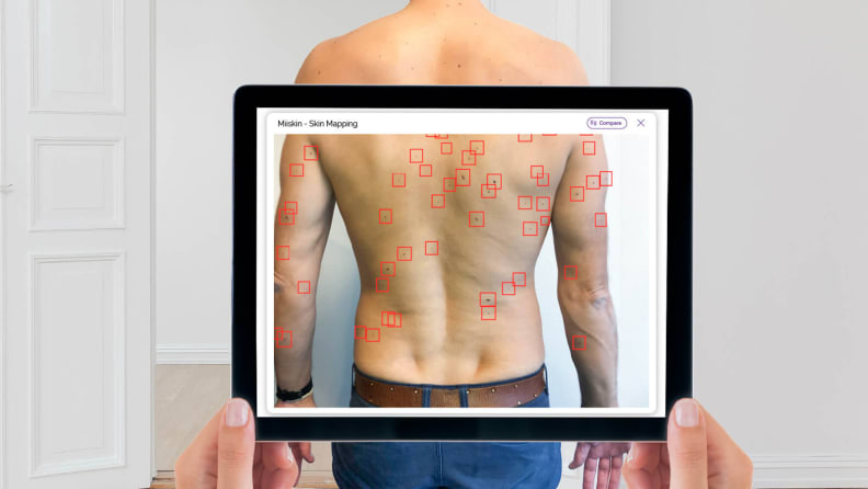 A person uses the MiiSkin app to examine another individual's bare back.