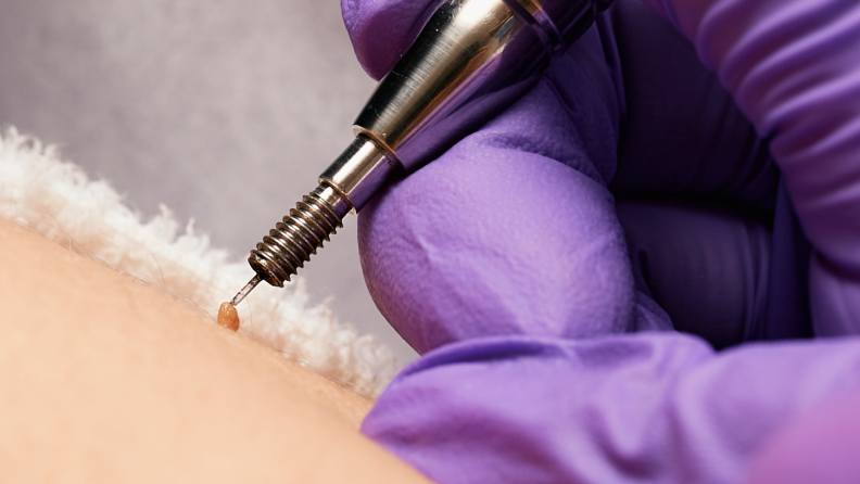 A person removes a skin tag with a needle.