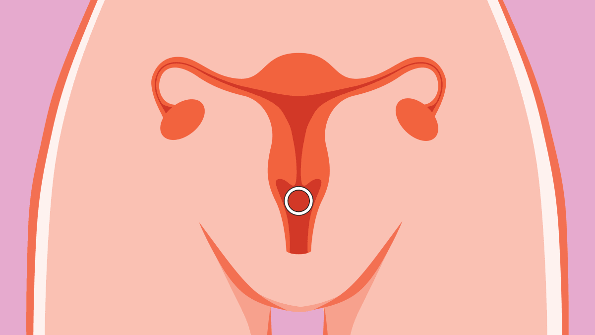 Annovera vs. NuvaRing Is a vaginal ring the right birth control for