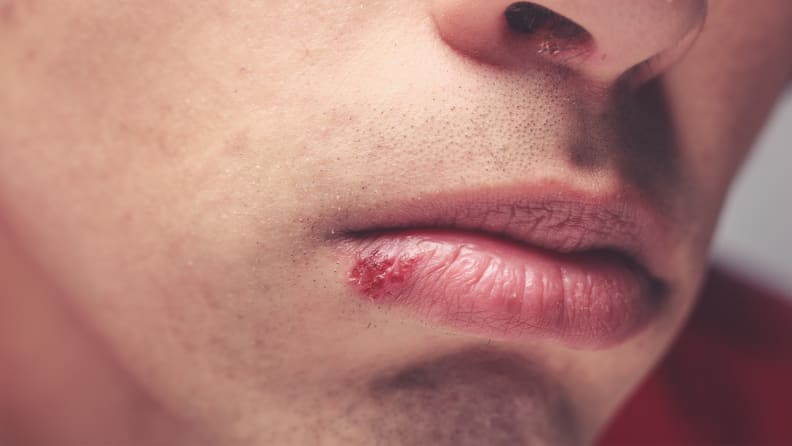 how to get rid of cold sores on your lip