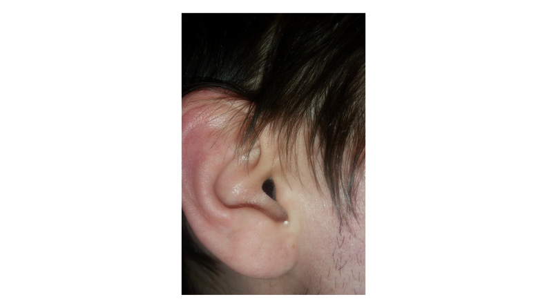 hearing aid in ear view