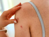 Here's why you have acne, according to where it is on your body
