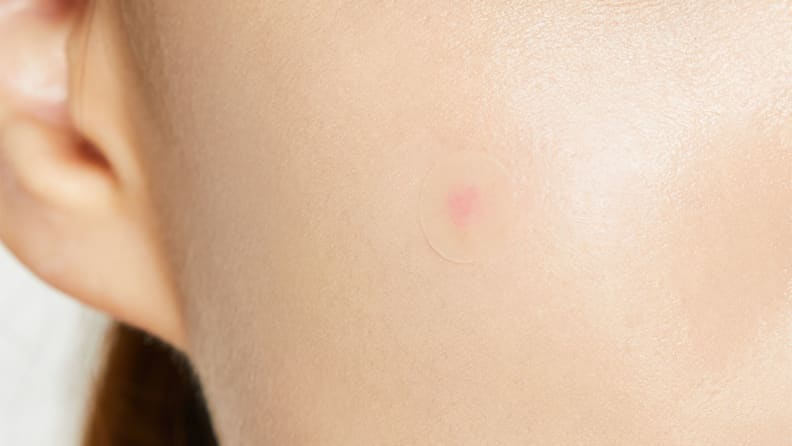 A woman wearing an acne patch.