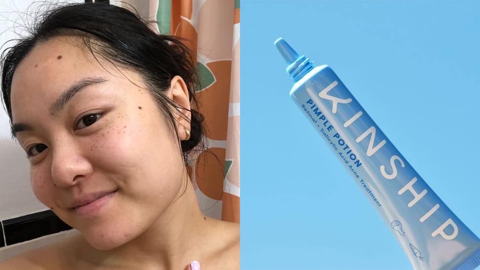 On the left: The author tilting her head to show her acne-free skin and smiling. On the right: A light blue squeeze tube lifted up against a blue background.