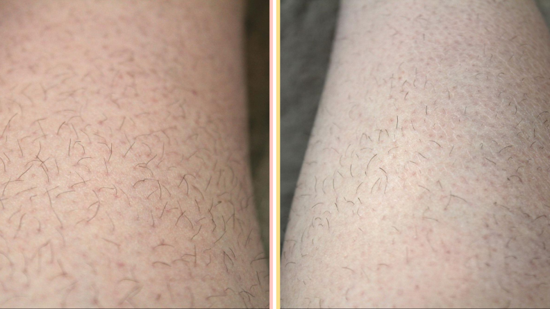 Before and after pictures for the Lumi permanent hair removal device.