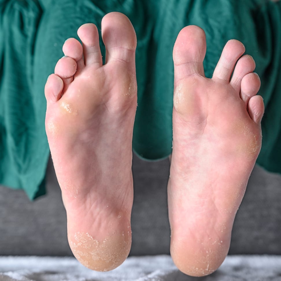 Why Are My Feet Peeling? – My FootDr