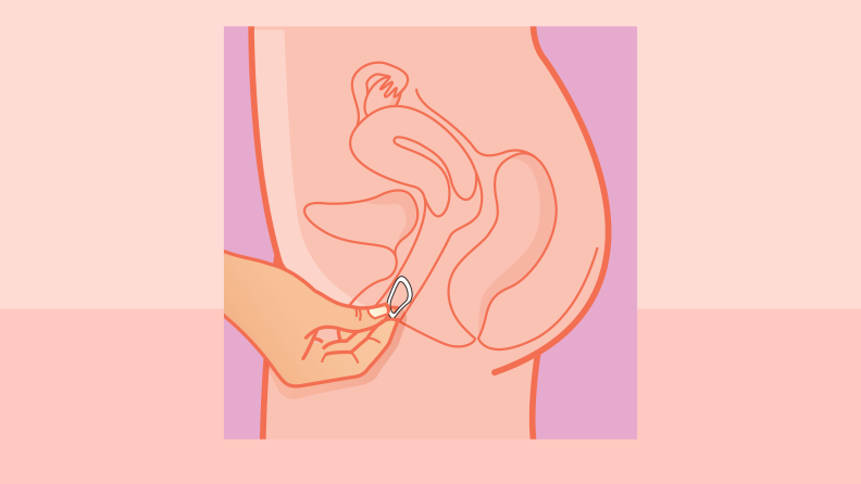 Infographic of someone inserting ring contraceptive into uterus.