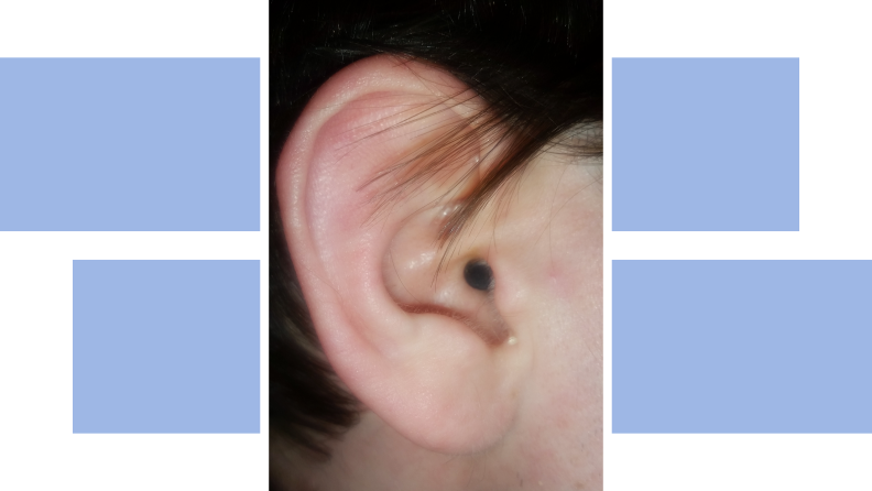 An invidiible hearing aids sits in a testers ear. The image is on a colorful background
