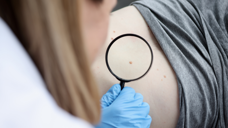 A doctor examines a body with moles and skin tags.