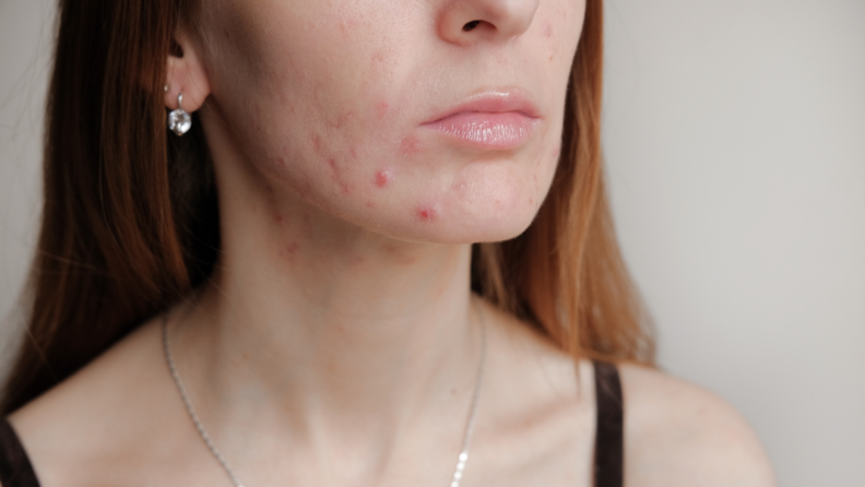 Close-up of person with acne on their chin and neck area.