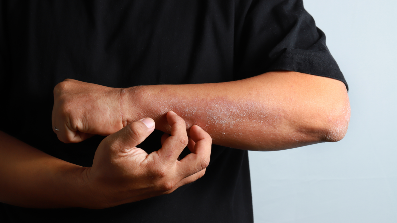 A man scratching the dry, flaky skin on his arm
