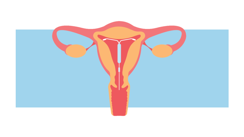 Animated graphic of uterus.