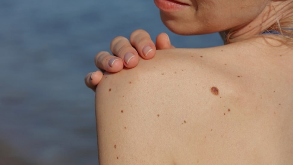 Monitor your skin cancer risks at home with this phone app
