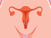 Infographic of hormonal birth control ring inserted into cartoon uterus.