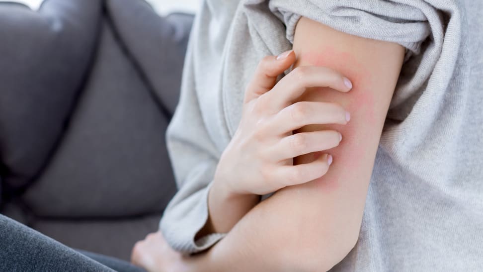 What is eczema—and how can you treat it?