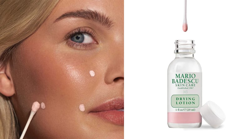 On the left: A person using a cotton swab to apply pink acne lotion to their face. On the right: A clear bottle of acne solution with a cotton swab above it.