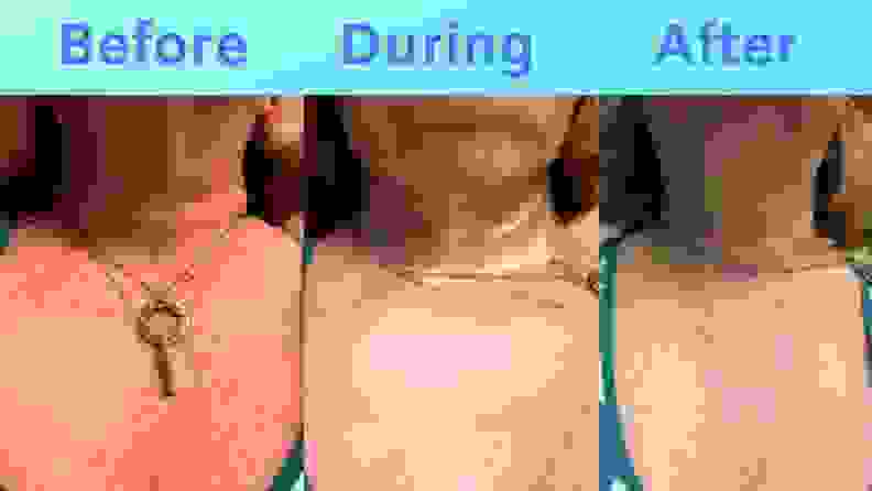 Three images showing Sue's chest: Before SiO, during SiO with patches applied, and after SiO