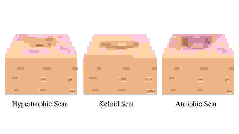A diagram shows three types of acne scarring: hypertrophic, keloid, and atrophic.