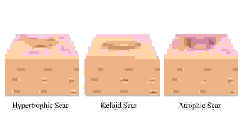图表显示了三种类型的痤疮疤痕:肥厚型、瘢痕疙瘩型和萎缩性。