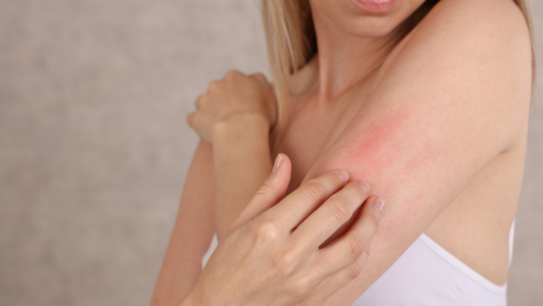 A woman scratching her skin as her eczema appears red and scaly on her arm
