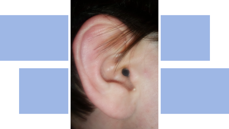 Close up shot of person wearing the Eargo 7 hearing aid in ear canal.