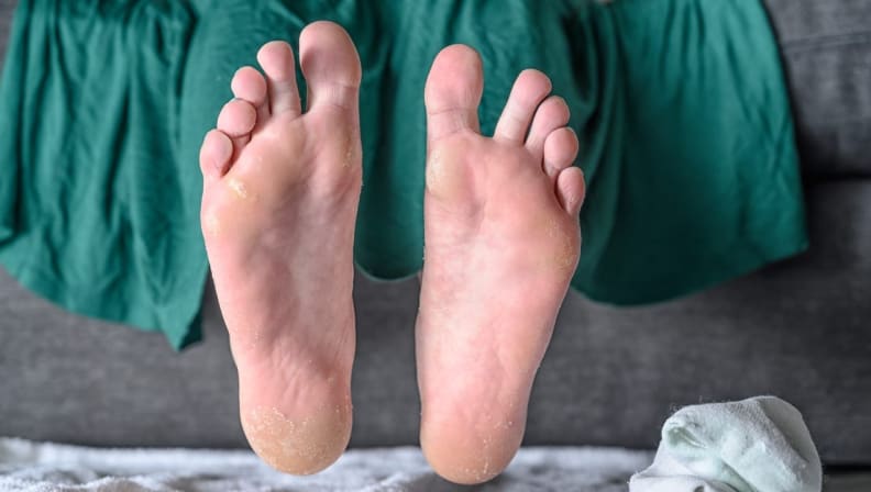 Baby Foot peel